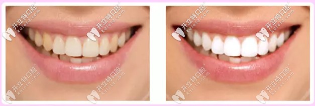 皓齿美白效果