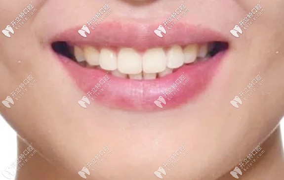 在广州全家福口腔做完矫正后的牙齿图