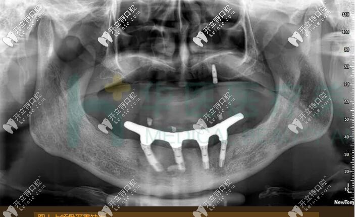 呼和浩特华医口腔牙槽骨重度缺失老人在呼和浩特华医口腔做了穿颧种植手术