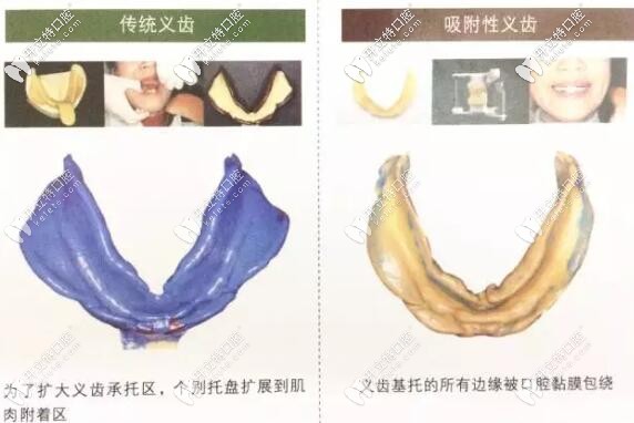 全口生物功能吸附性义齿和普通假牙的区别