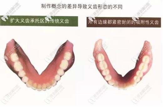 bps全口吸附性义齿和普通假牙的区别