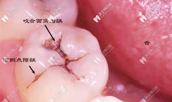 牙齿表面有黑点就是蛀牙哦,此时补牙能省很多钱呢！