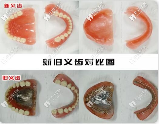 吸附性义齿与普通义齿的区别