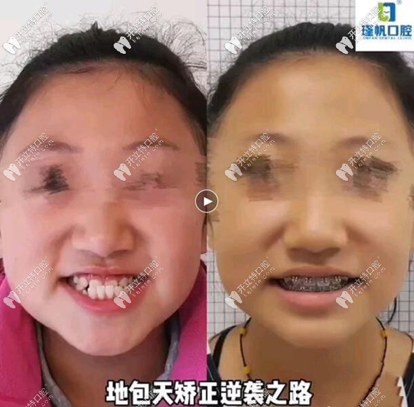 桂林瑾帆口腔今天晒出:姑娘12岁做地包天牙齿矫正的前后对比照片