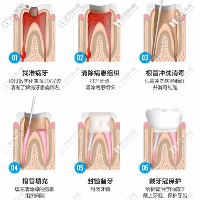 显微镜根管治疗术过程的步骤 显微镜根管治疗术过程的步骤