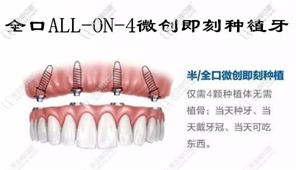 厦门allon4全口微创即刻负重种植牙价格