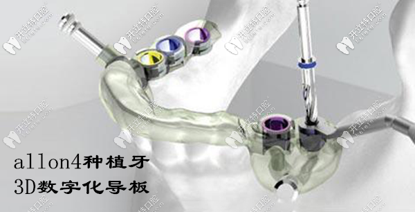 厦门种植全口牙的费用