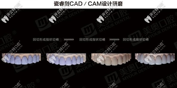 瓷睿刻CAD/CAM设计