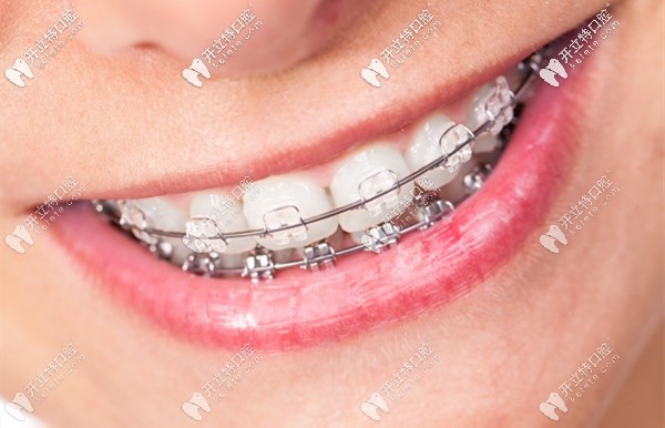 广州好大夫口腔的正畸费用介绍 广州好大夫口腔的正畸费用介绍