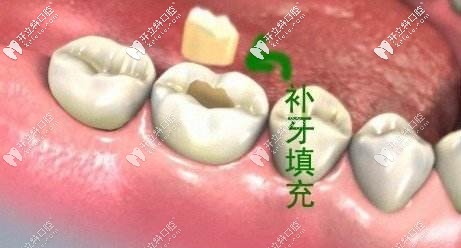 3M纳米树脂补牙各型号的区别及用途