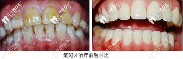 氟斑牙做emax全瓷牙贴面 氟斑牙做emax全瓷牙贴面