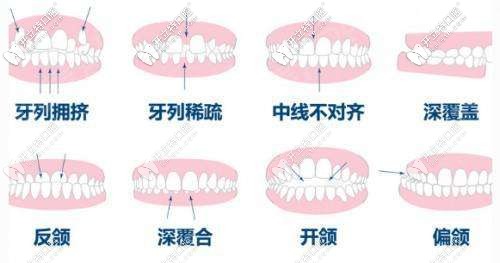 矫正器能改善牙齿错颌的问题
