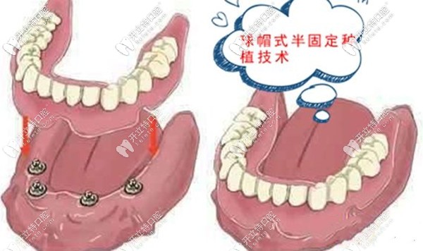 深圳尔睦口腔半口半固定种植牙
