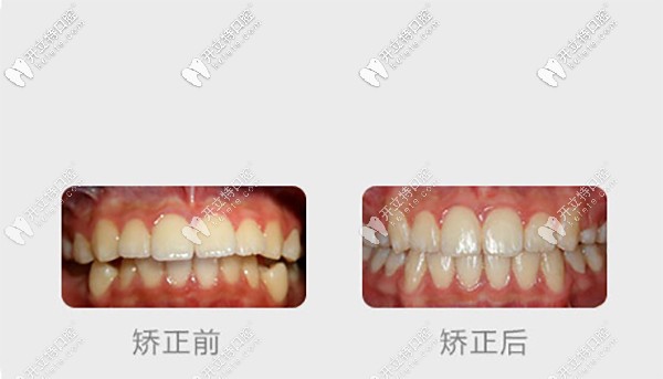 南京博韵口腔做金属托槽矫正的案例 南京博韵口腔做金属托槽矫正的案例