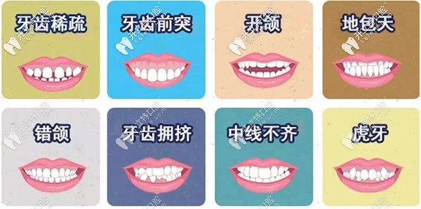 金属托槽矫正适应症 金属托槽矫正适应症