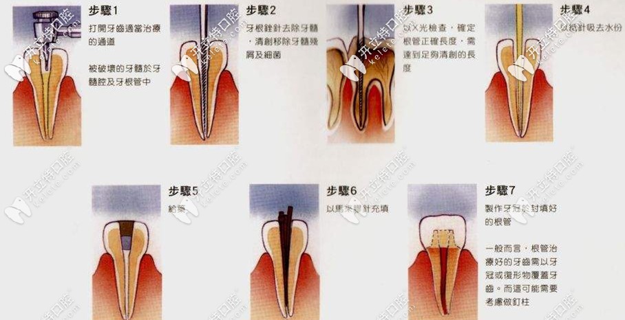 根管治疗的全部过程