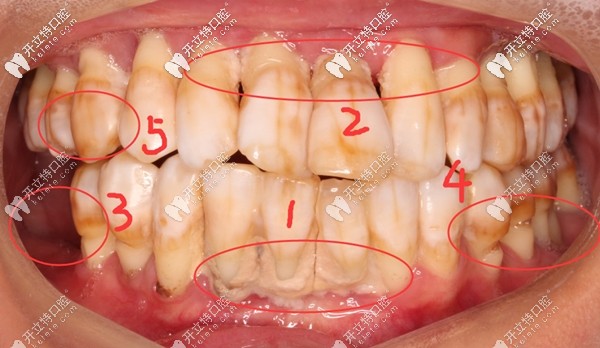 顾客种牙前的口内照 顾客种牙前的口内照