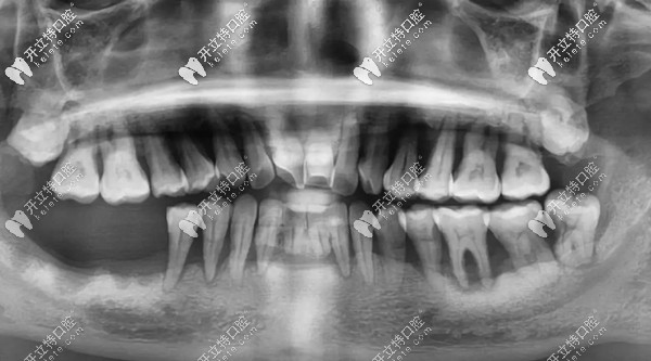 顾客做全口种植牙前的全景片图 顾客做全口种植牙前的全景片图