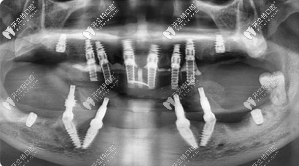 all-on-4/6全口即拔即种的线片图 all-on-4/6全口即拔即种的线片图