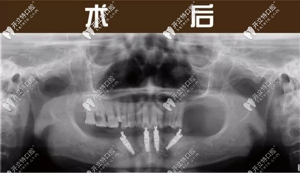 下半口做完4颗种植牙的全景片图