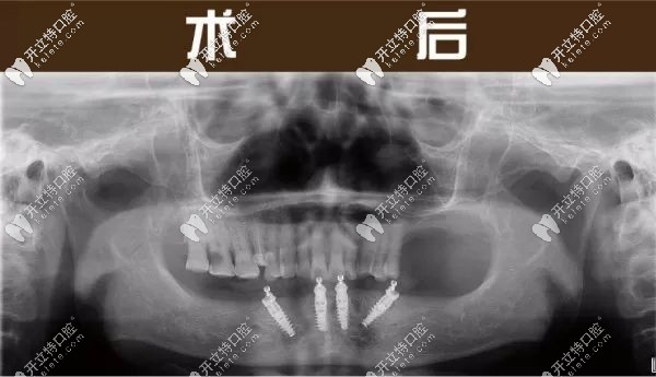 下半口做完4颗种植牙的全景片效果图