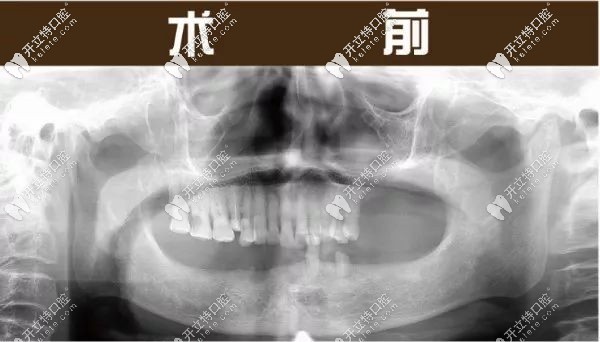 刘叔叔来杭州美奥口腔咨询时的口内照