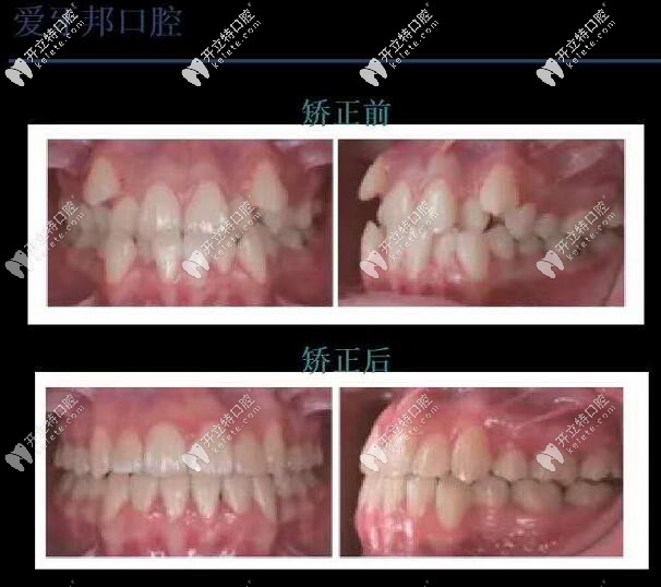 反颌矫正 娄底爱牙邦口腔医院