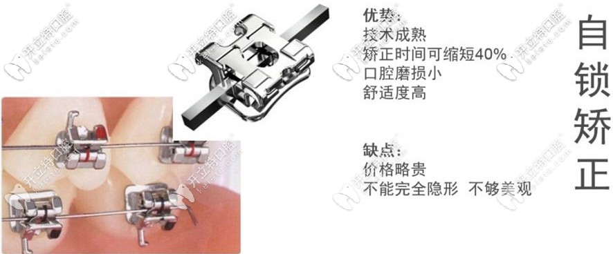 金属自锁矫正的特点