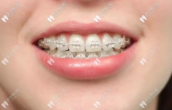 广州华医口腔正畸医生教大家如何选择牙套