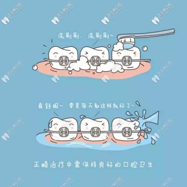 正畸期间注意牙齿卫生 正畸期间注意牙齿卫生