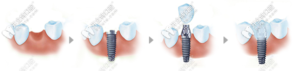 种植牙的过程示意图 种植牙的过程示意图