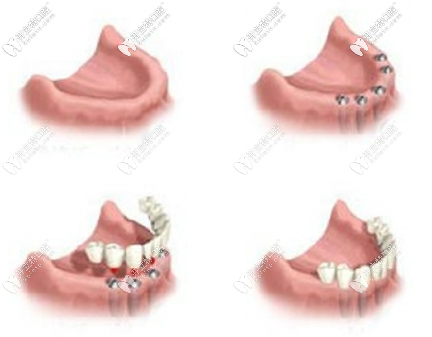 适合做种植牙的人群 适合做种植牙的人群