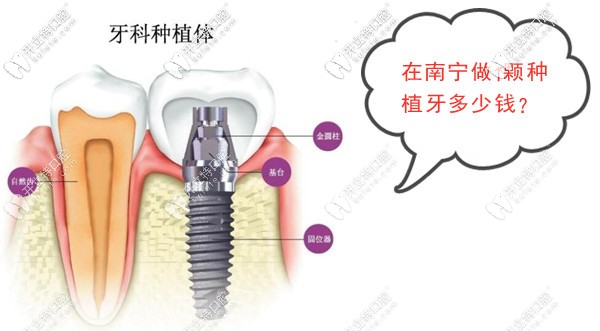 南宁做1颗种植牙的价格是多少钱?韩系和欧美进口的种植体