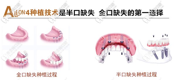 北京市朝阳区维乐做allon4速导半口种植牙价格是多少？