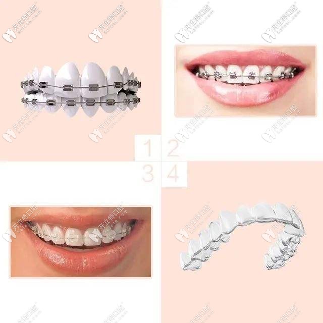 牙套的各种类型