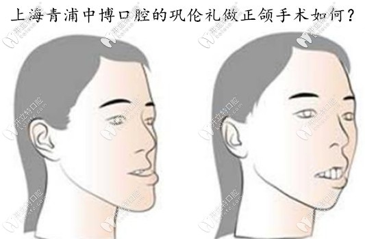 谁知道上海中博口腔做地包天正颌手术的医生是谁？