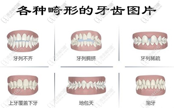 各种畸形的牙齿图片