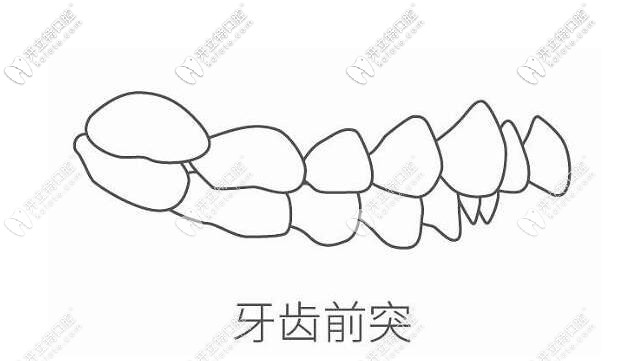 牙齿前突