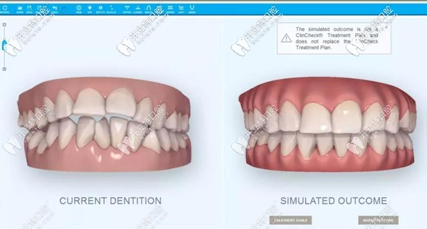 隐适美iTero口扫仪呈现的矫正效果图