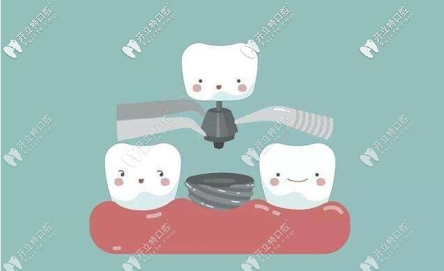 韩国和德国种植牙的寿命相差多少,哪种能用的更久