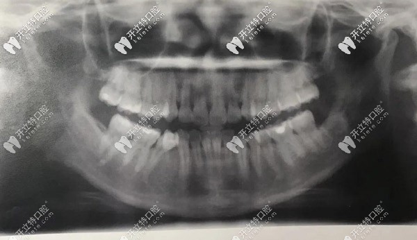 全口X光，牙齿很不齐