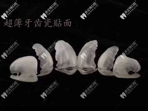 西安林牙立齿口腔西安雁塔区牙科分享:超薄瓷贴面改善满口黄牙的真实案例