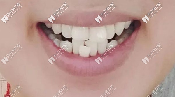小姐姐戴牙套整牙前的牙齿图