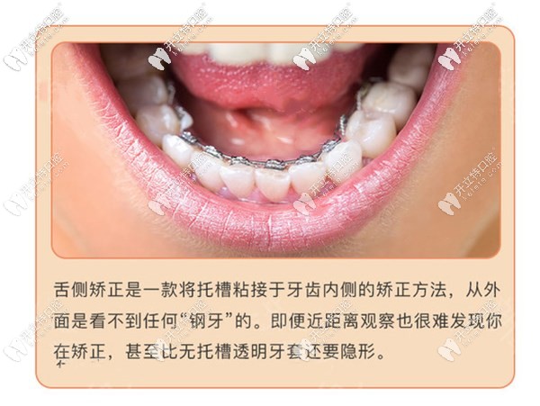广州舌侧矫正哪个医院好?广州舌侧成熟医院医生及价格推荐
