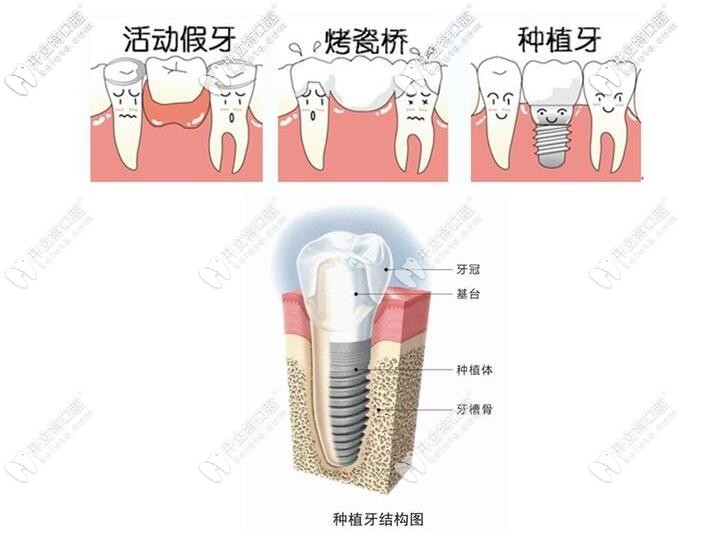 种植牙的结构