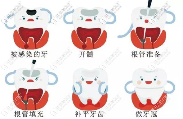 牙齿做根管治疗的示意图 牙齿做根管治疗的示意图