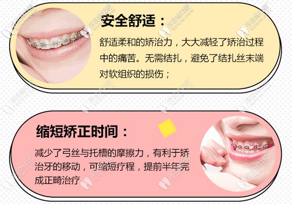 金属自锁钢丝牙套矫正 金属自锁钢丝牙套矫正
