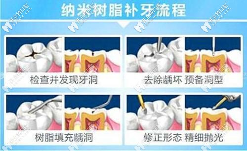 树脂补牙过程