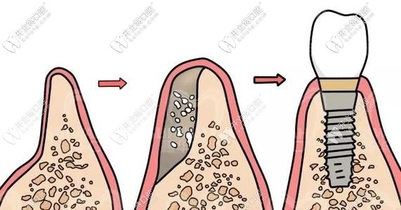 种植牙植骨粉示意图
