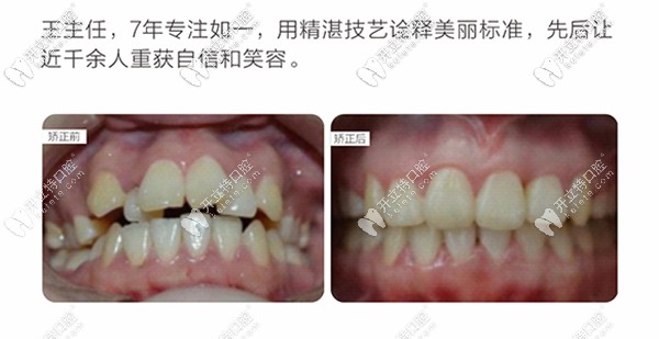 成人口呼吸矫正(2)